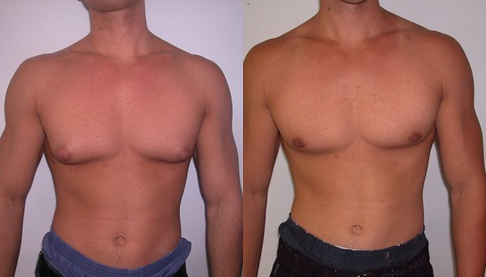 antes y despues de una cirugia de ginecomastia